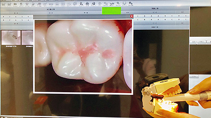 中村日赤駅・土屋歯科クリニック・説明ツール（口腔内カメラ・説明用モニター）