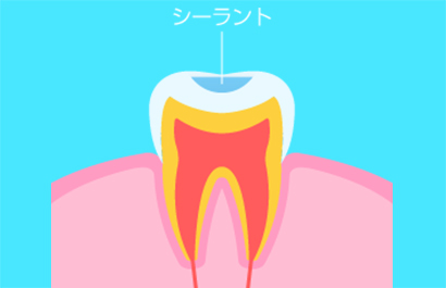 中村日赤駅・土屋歯科クリニック・シーラント